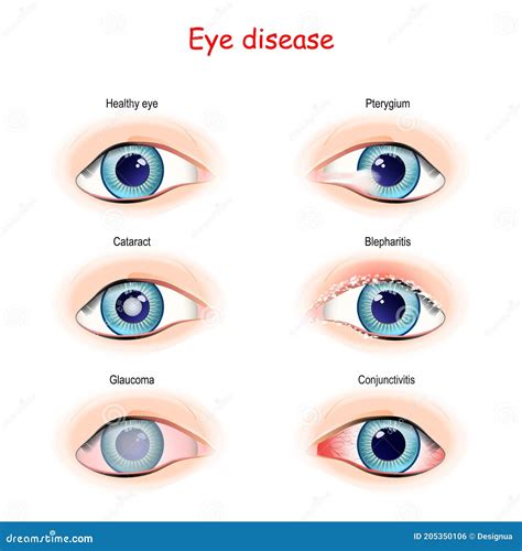 Eye Disease Comparison And Difference Stock Vector Illustration Of