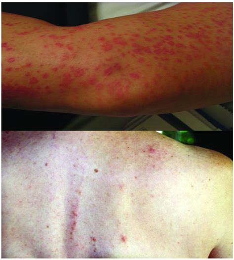 Characteristics And Management Of Rash Following Lenalidomide And