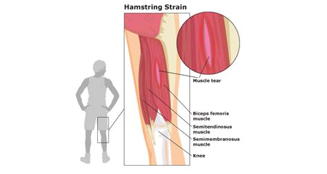 Do You Experience Lower Limb Muscle Strains Preventing And Treating