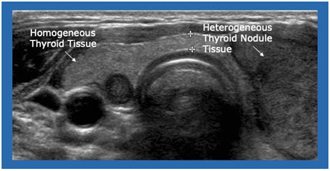 Thyroid Ultrasound Trilogy Ii Common Ultrasound Terms You Might