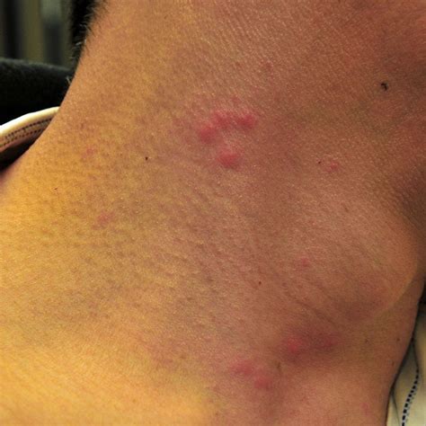 Pics Of Bed Bug Bites On Neck Pest Phobia