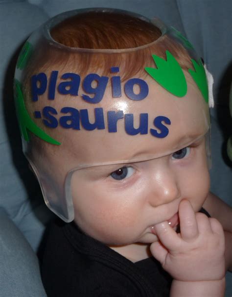 Pin On Torticollis Plagiocephaly Doc Band