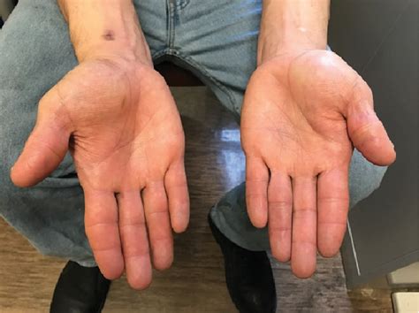 Figure 4 From Disabling Dactylitis And Tenosynovitis Due To