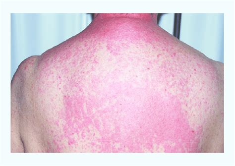 Maculopapular Eruption Of The Trunk In Drug Reaction With Eosinophilia
