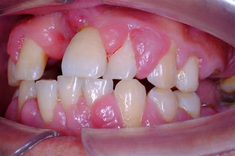 How To Manage Drug Induced Gingival Hyperplasia Dentistry