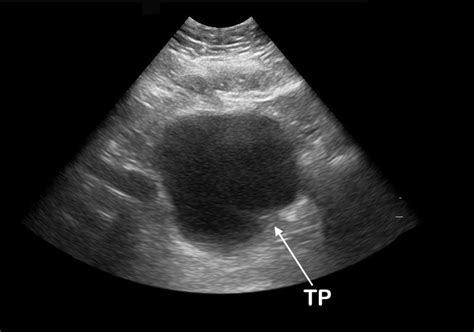 Bladder Bulge Unifying Old And New Sonographic Bladder Wall