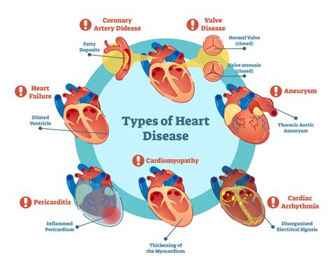 Heart Disease Explained—the Many Risk Factors Causes And Treatment