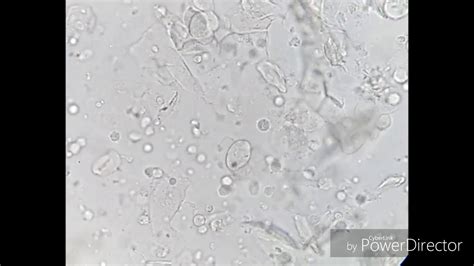 Trichomonas Vaginalis Bacteria And Yeast Cells Under The Microscope