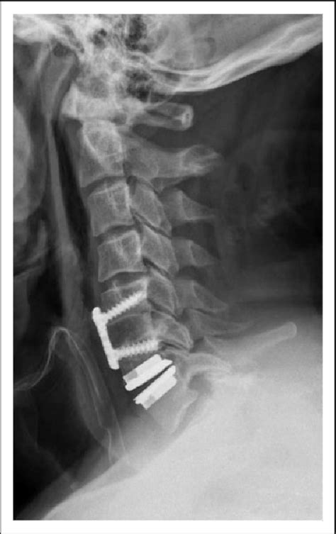 Hybrid Construct With Anterior Cervical Discectomy And Fusion Acdf