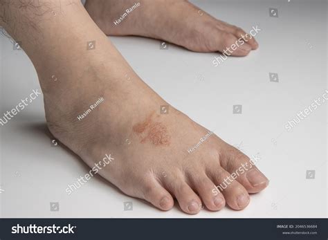 Side View Foot Infected Ringworm Athletes库存照片2046536684 Shutterstock