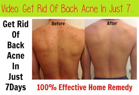 Get Rid Of Back Acne In Just 7 Days 100 Effective Home Remedy Acne