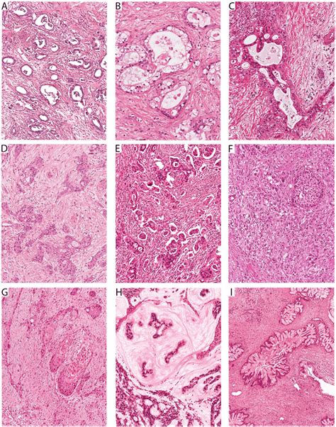 Spectrum Of Histologic Patterns In Pancreatic Ductal Adenocarcinomas