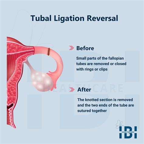Tubal Ligation Reversal Womens Reproductive Health Center