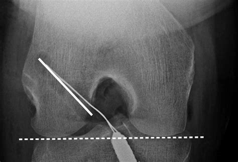 Notch View Radiograph Of Right Knee Case 3 The Femoral Tunnel
