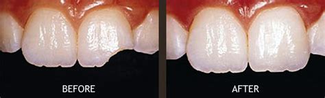 White Fillings Composite Fillings Visit Healthy Smiles Dental