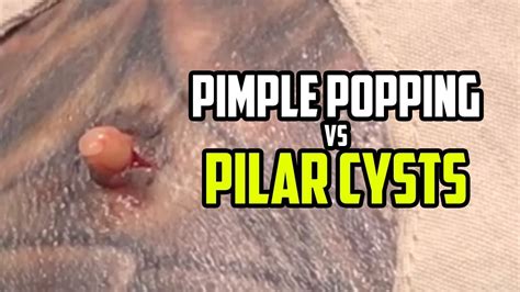 Pimples Vs Pilar Cysts Bonus Comedone Extractor Tools Youtube