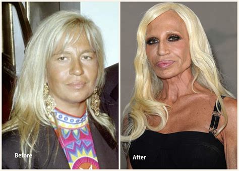 donatella versace plastic surgery before and after photo showing lip surgery nose surgery and