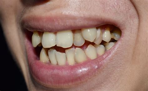Overlapping Teeth Causes Issues And Treatment Options