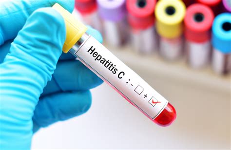 hepatitis c and hiv aidsmap