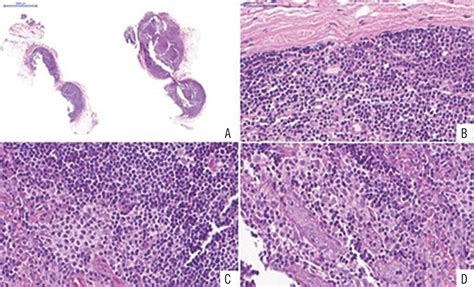 Scielo Brasil Parotid Follicular Lymphoid Hyperplasia A Rare