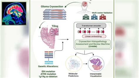 This Ai Tool Can Help Doctors Treat Brain Tumours Quickly And