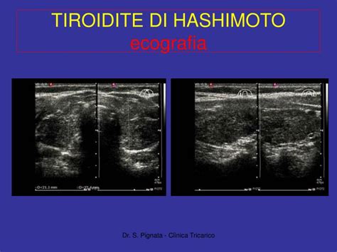 Ppt Le Tiroiditi “ Ecografia Ed Ecocolor Doppler Nella Tiroidite Di