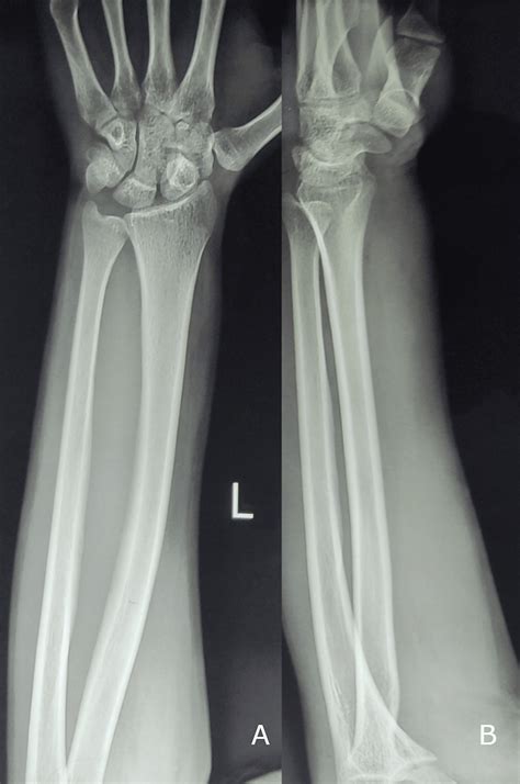 Cureus An Unusual Presentation Of A Rare Disease Eosinophilic Fasciitis