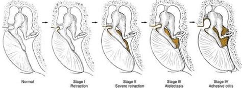 Four stages of middle ear atelectasis Adapted from Sadé J Berco E Download Scientific