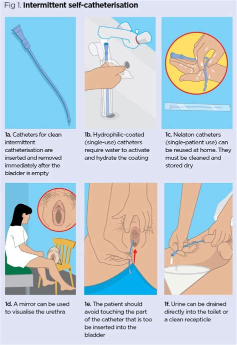 Self Catheterization Female Pdf Catheter Placement Video Real Patient