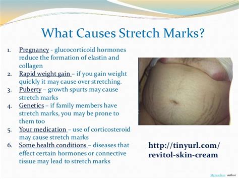What Is The Best Cream For Stretch Marks