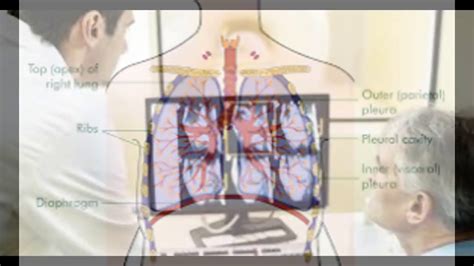 It can be measured for a particular location, like a state, or for a disease like malignant mesothelioma. malignant pleural mesothelioma survival rate - YouTube