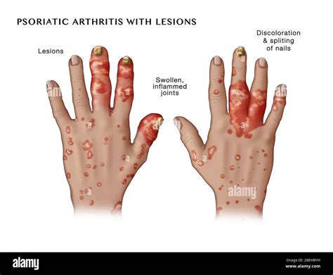 Psoriatic Arthritis With Lesions Stock Photo Alamy
