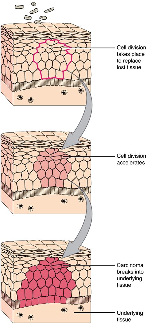 Cancer cells grow at an uncontrolled rate. This series of three diagrams shows the development of cancer in epithelial cells. In all three ...