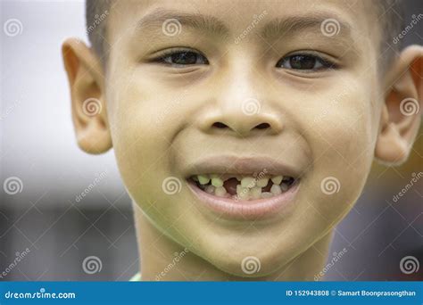 Baby Teeth Are Just Dropped In The Mouth Stock Photo Image Of Closeup