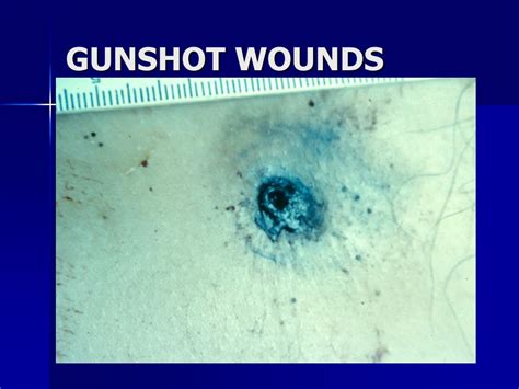 More images for gunshot wounds pathology » PPT - FORENSIC PATHOLOGY PowerPoint Presentation, free download - ID:3566989