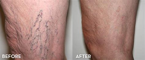 Sclerotherapy Spider Vein Treatment Springfield Mo