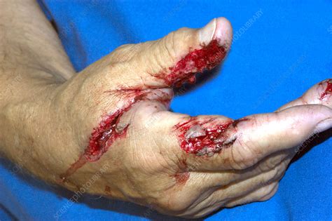 Hand Laceration - Stock Image - M330/1263 - Science Photo Library