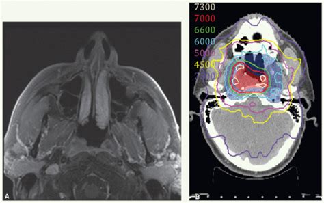 Nasopharynx Radiology Key