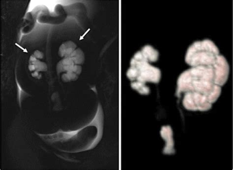 Bilateral Hydronephrosis Identified On Fetal Mri T2 50 Mm T Slab