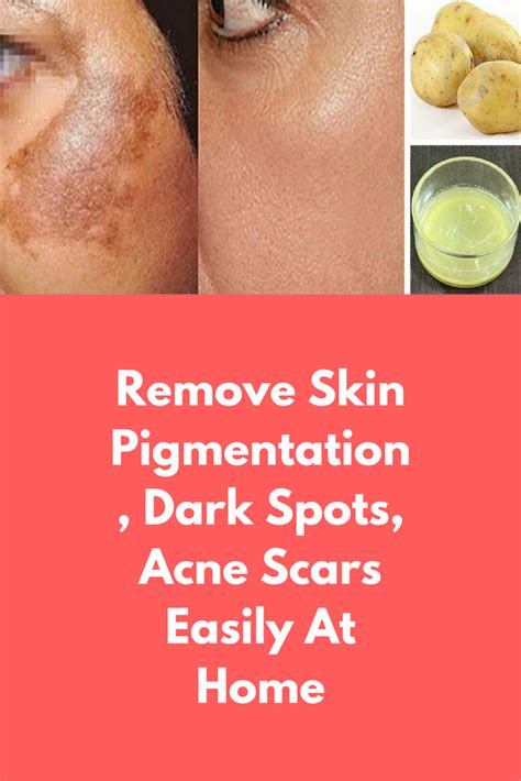 Home Remedies For Acne And Dark Spots Home Sweet Home Modern Livingroom