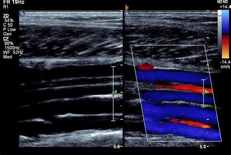 Leg Dvt Normal Ultrasoundpaedia Ultrasound Sonography Vascular