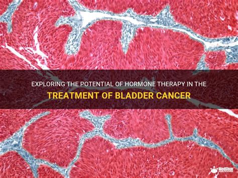 Exploring The Potential Of Hormone Therapy In The Treatment Of Bladder