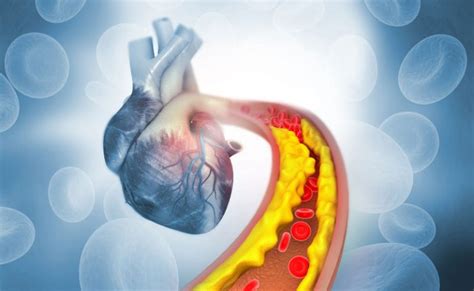 Preventing Cardiovascular Disease Heart And Vascular Wellness Center
