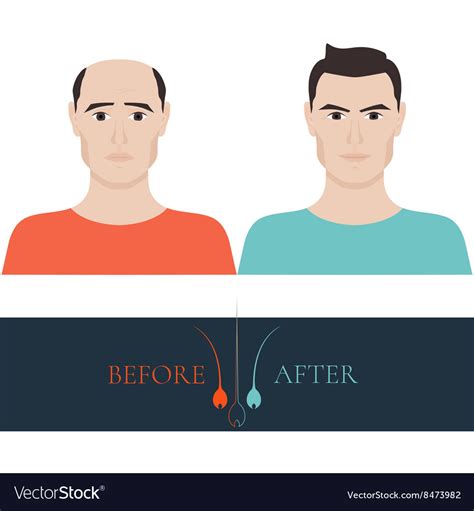 Before And After Hair Loss Treatment Royalty Free Vector