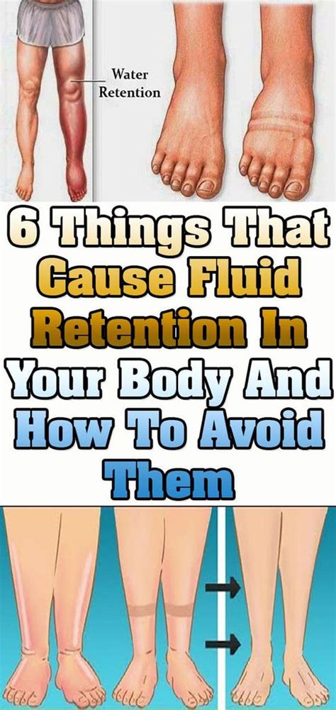 6 Things That Cause Fluid Retention In Your Body And How To Avoid Them Healthy Lifestyle
