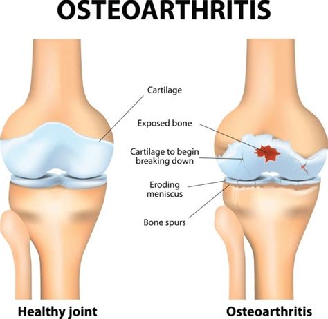 Knee Osteoarthritis The 5 Symptoms You May Have Elevate Physiotherapy