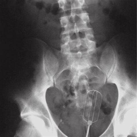 Buzz Lightyear And Mobile Phones Xrays Of Odd Objects Used In Sex Daily Star