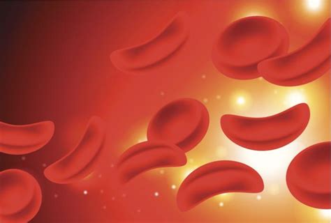 Sichelzellenanämie form der anämie (blutarmut), bei der der aufbau des blutfarbstoffs hämoglobin aufgrund eines erblichen. Sichelzellenkrankheit: Überblick, Symptome und Ursachen ...