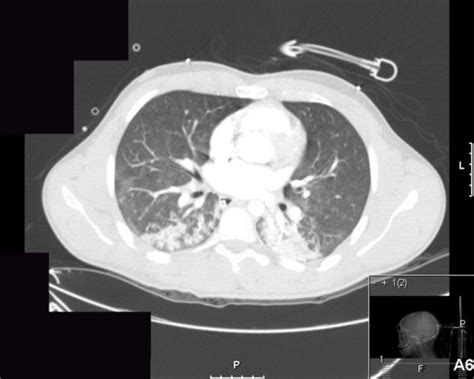 Ct Scan Of The Chest Showing Bilateral Bibasilar Infiltrates