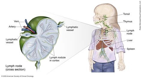 Lymphoma Non Hodgkin Childhood Medical Illustrations Cancernet